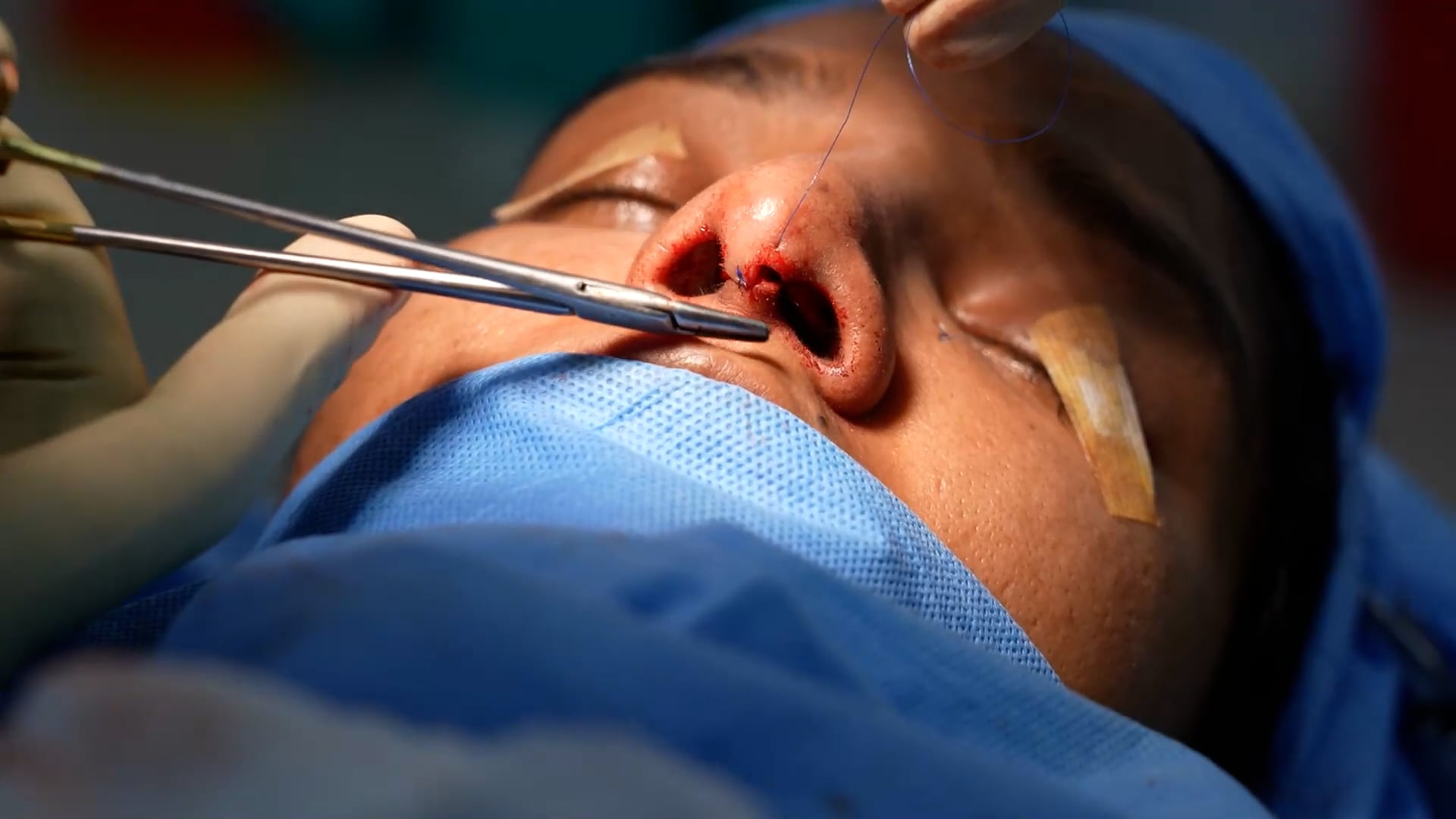 Open Rhinoplasty- Female patient